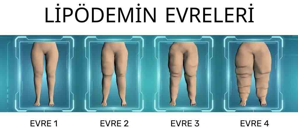 Lipodem Evreleri