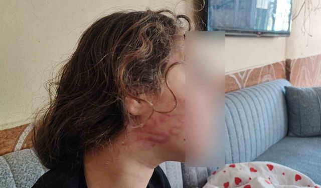 Adana'da Akılalmaz Şiddet: 11 Yaşındaki Epilepsi Hastası Kızı Dövdü!