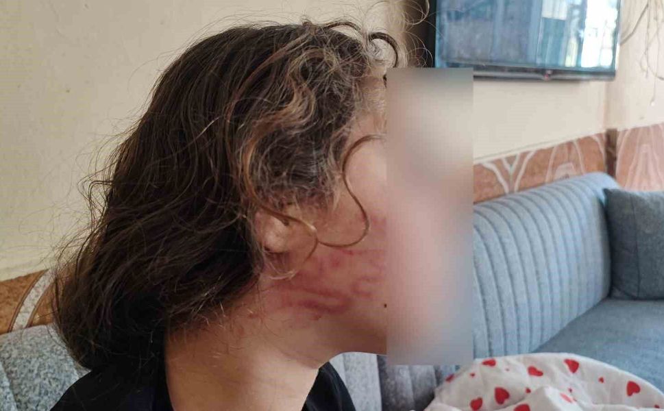 Adana'da Akılalmaz Şiddet: 11 Yaşındaki Epilepsi Hastası Kızı Dövdü!